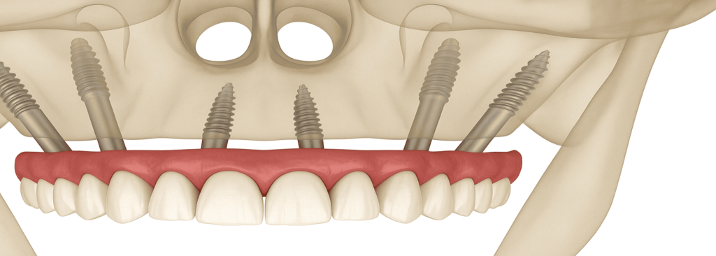 What are pterygoid dental implants?